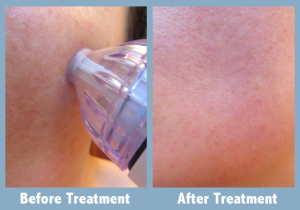 PMD Personal Microderm Device Before and After Treatment