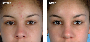Personal Microderm Device Before and After Acne