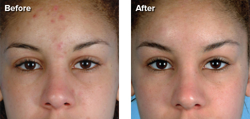 Personal Microderm Device Before and After Acne - Inspirations and  Celebrations