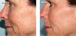 Personal Microderm Device Before and After Wrinkled Skin