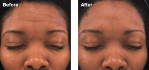 Personal Microderm Device Before and After Wrinkles