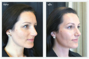 Face First Laser Skincare Series - Before and After Photos